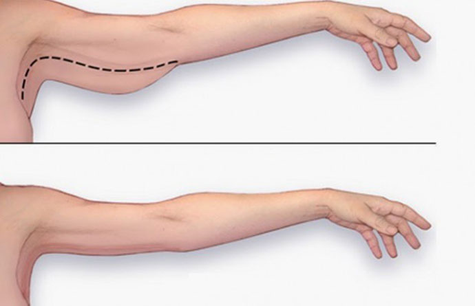 Massage giảm mỡ bắp tay