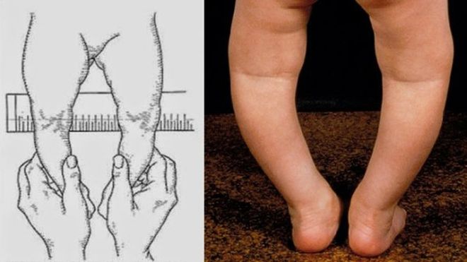 Đai nẹp chân vòng kiềng có hiệu quả không