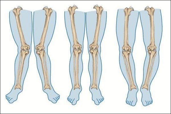 Đai nẹp chân vòng kiềng có hiệu quả không