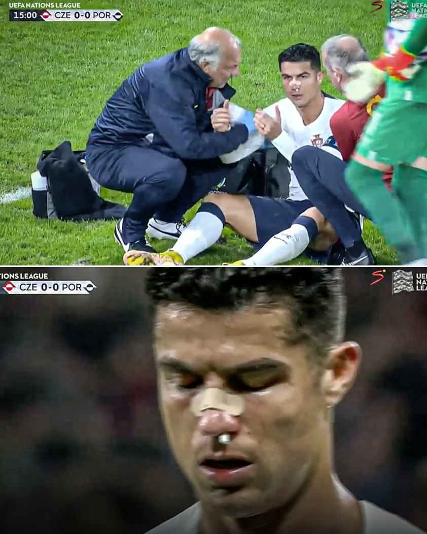 Ronaldo chảy máu đầm đìa đầy ghê rợn khi thi đấu, hình ảnh khiến fan không khỏi xót xa 192725