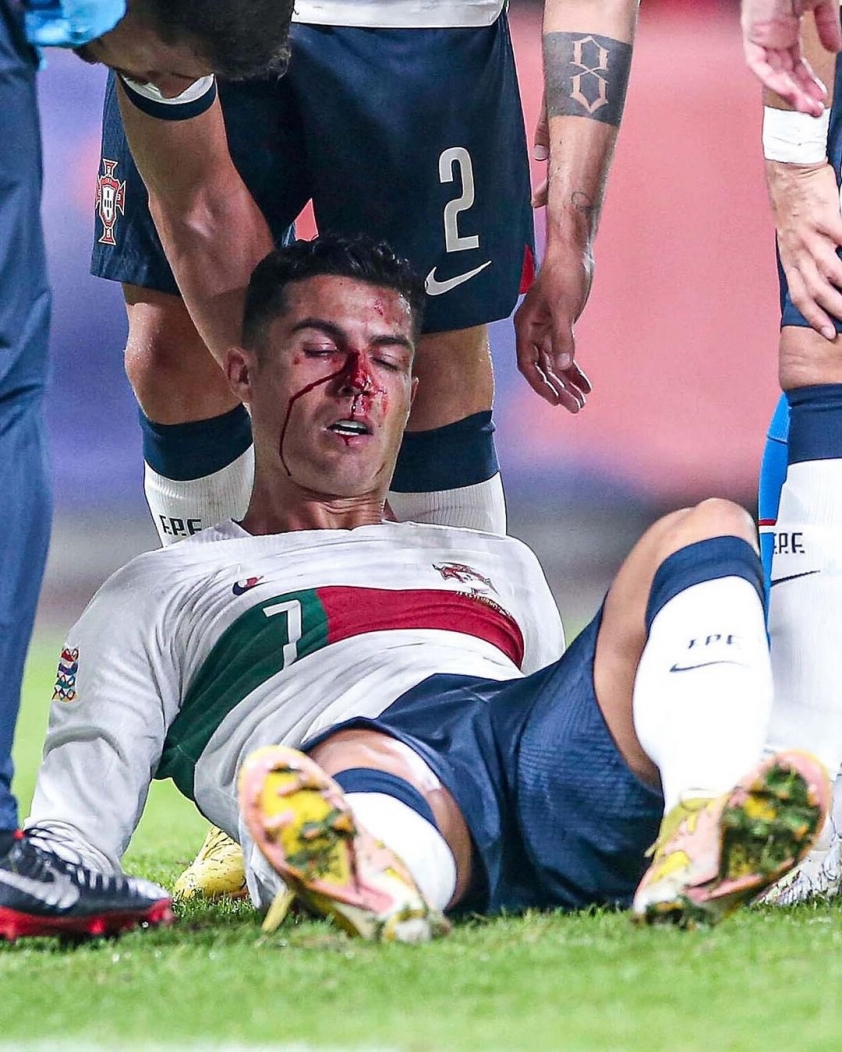 Ronaldo chảy máu đầm đìa khi thi đấu, hình ảnh khiến fan không khỏi xót xa 192722