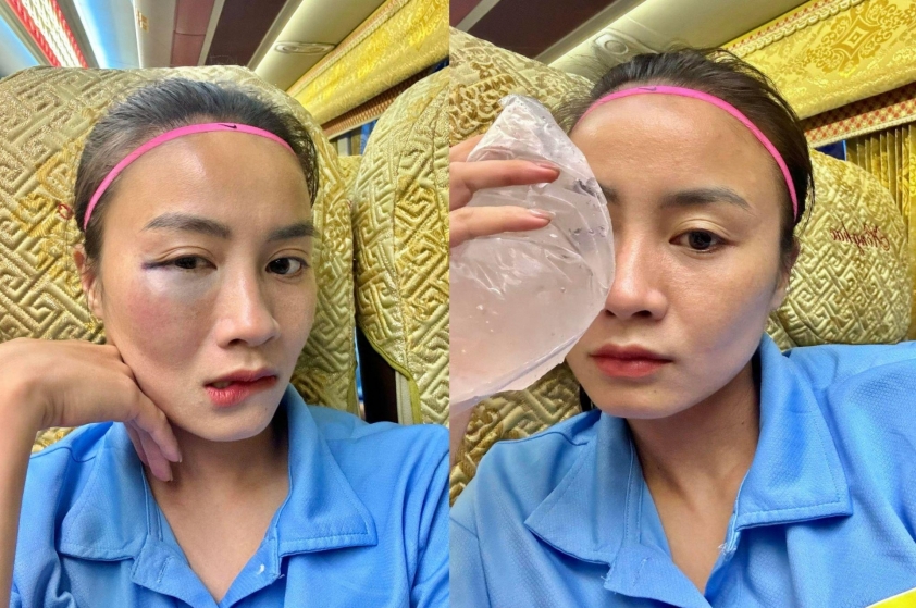 Hot girl ĐT nữ Việt Nam bầm tím mặt sau khi thi đấu 698575