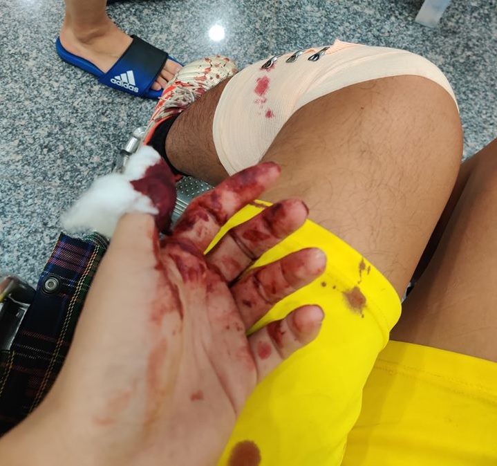 Cầu thủ phủi bị đánh trọng thương, phải nhập viện khẩn cấp?