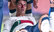 Ronaldo chảy máu đầy ghê rợn khi thi đấu, hình ảnh khiến fan không khỏi xót xa