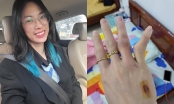 Sao bóng chuyền Geleximco Thái Bình khiến NHM sốc với bàn tay dị dạng