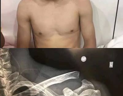 Xương vai đứt lìa, tiền đạo Trung Quốc vẫn lập cú đúp vào lưới Philippines