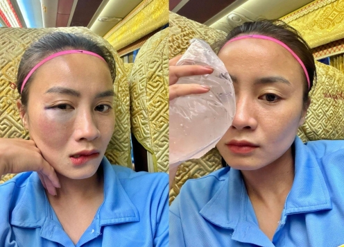 Hot girl ĐT nữ Việt Nam bầm tím mặt trong sau pha va chạm