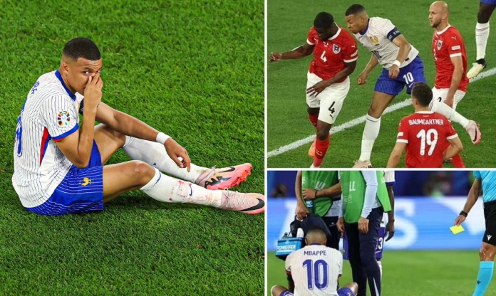 Cận cảnh chấn thương khiến mũi Mbappe biến dạng