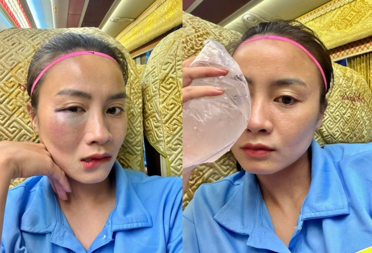 Hot girl ĐT nữ Việt Nam bầm tím mặt trong sau pha va chạm