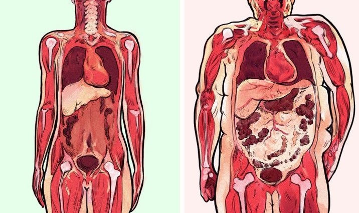 Mỡ bụng và 5 mối nguy hiểm mà ai cũng cần biết