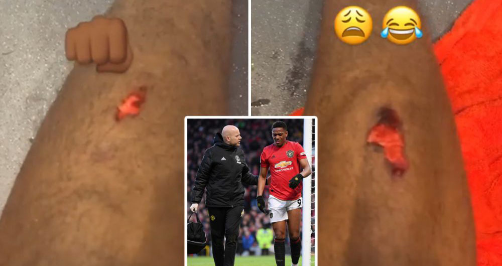 MU 2-0 Man City, MU, Man City, Ngoại hạng Anh, Premier League, Martial, chấn thương